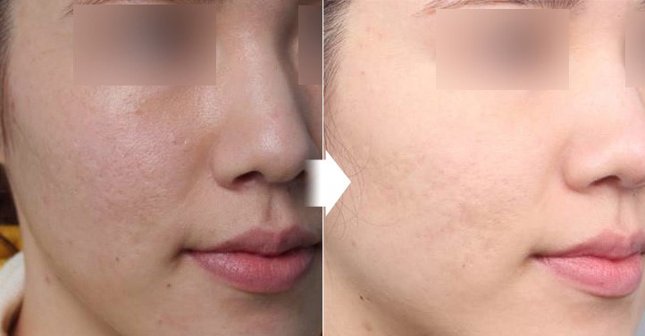 Acne Scar Healing Treatments in Korean Dermatology