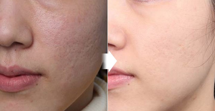 Acne Treatment Routines Recommended by Korean Experts