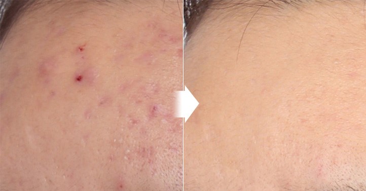 Advanced Acne Clearing Technologies in Korea