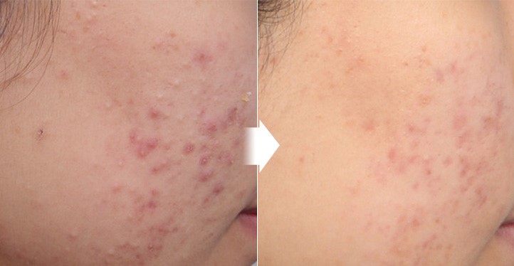 Effective Acne Treatment Options in Seoul, South Korea