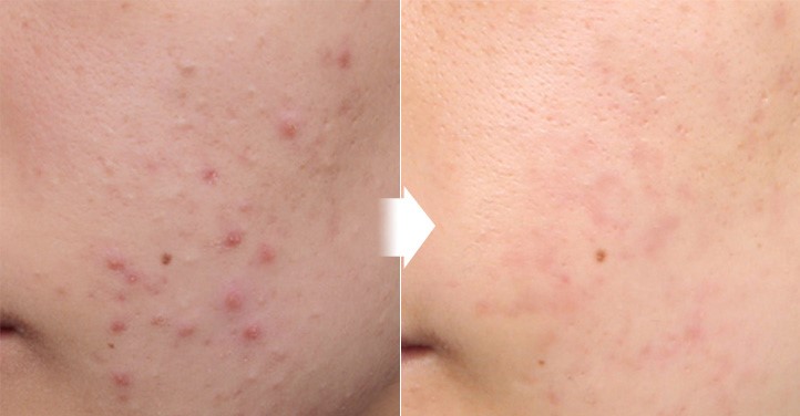 Guide to Professional Acne Clinics in Korea