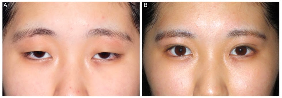 Пластические операции на глаза в Корее: Виды и особенности