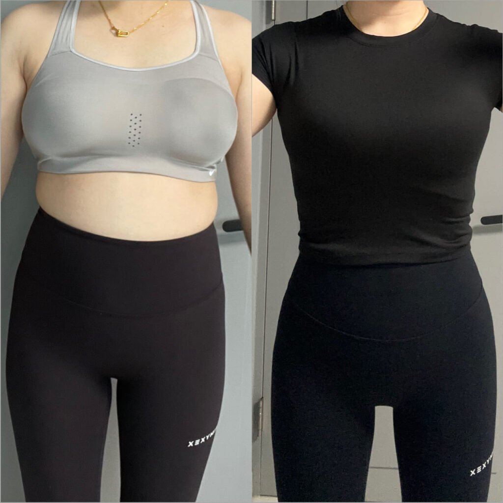 Abdomen and Waist Liposuction in Korea