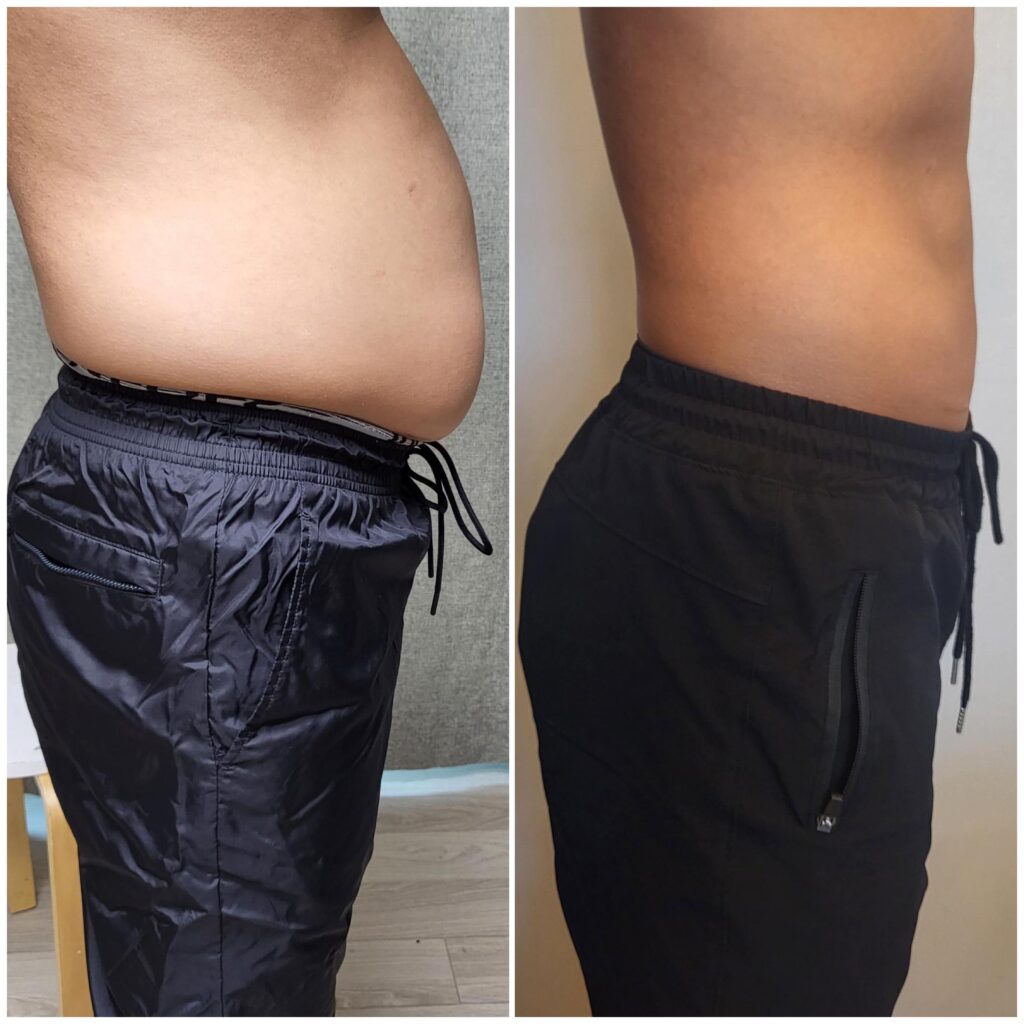 Abdominal Liposuction Clinics in Korea