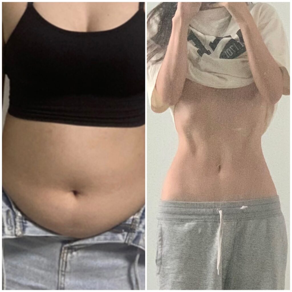 Abdominal Liposuction Reviews in Korea