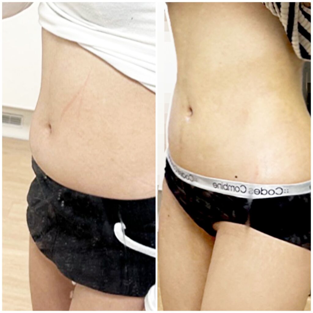 Abdominal Liposuction under General Anesthesia in Korea