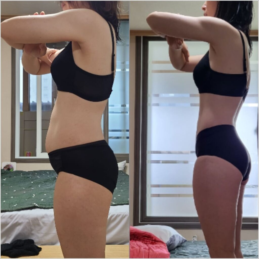 Abdominal Liposuction_ Before and After in Korea