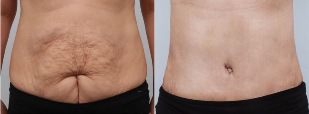 Abdominoplasty Photo Gallery in Korea