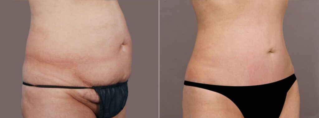 Abdominoplasty Process in Korea