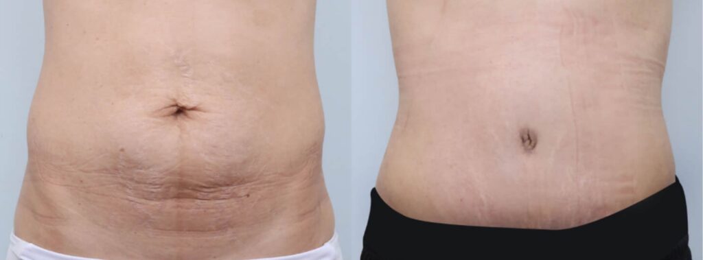 Abdominoplasty Results in Korea