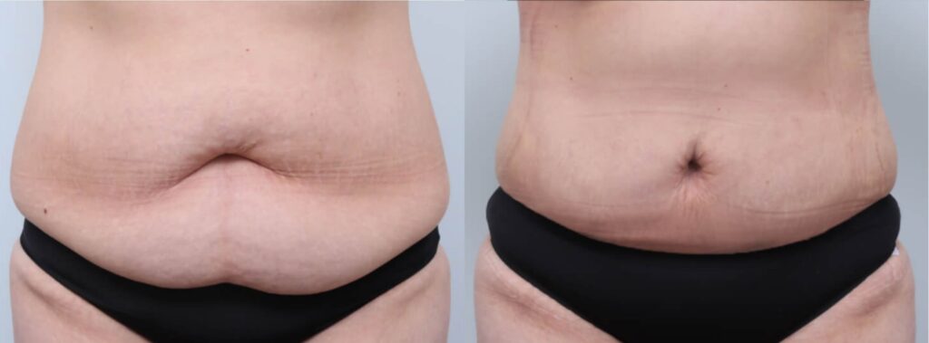 Abdominoplasty Reviews in Korea