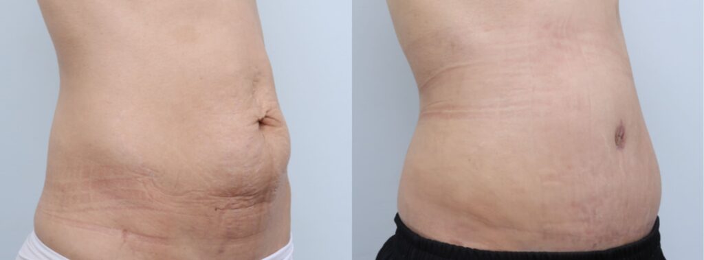 Abdominoplasty Techniques in Korea