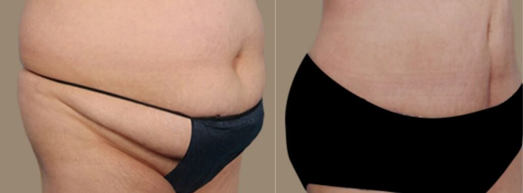 Abdominoplasty and Liposuction in Korea