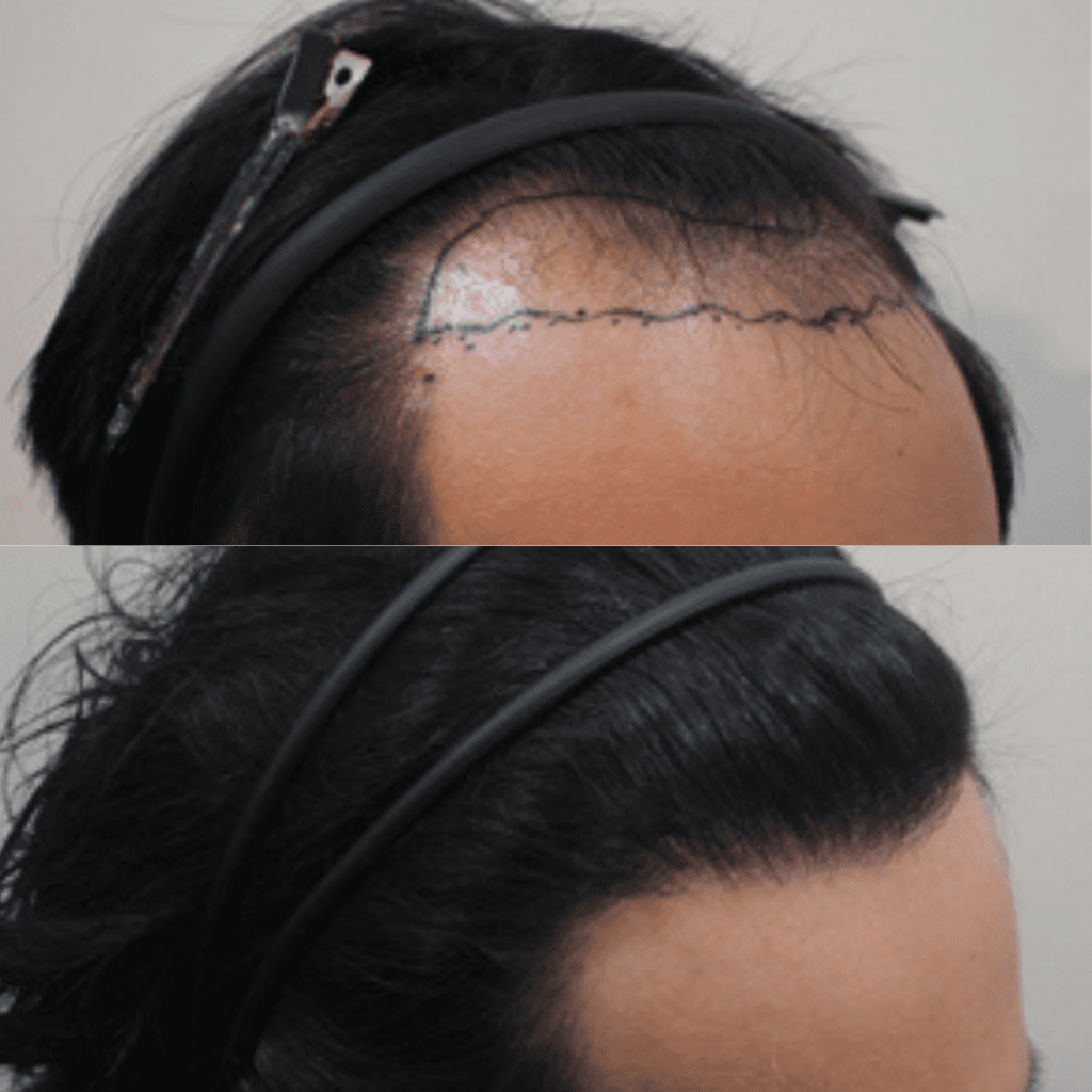 Achieving Density with Hair Transplant Procedures in Korea