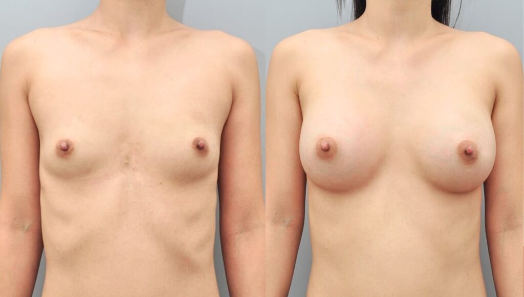 Achieving Harmony_ The Ideal Breast Size in Korea