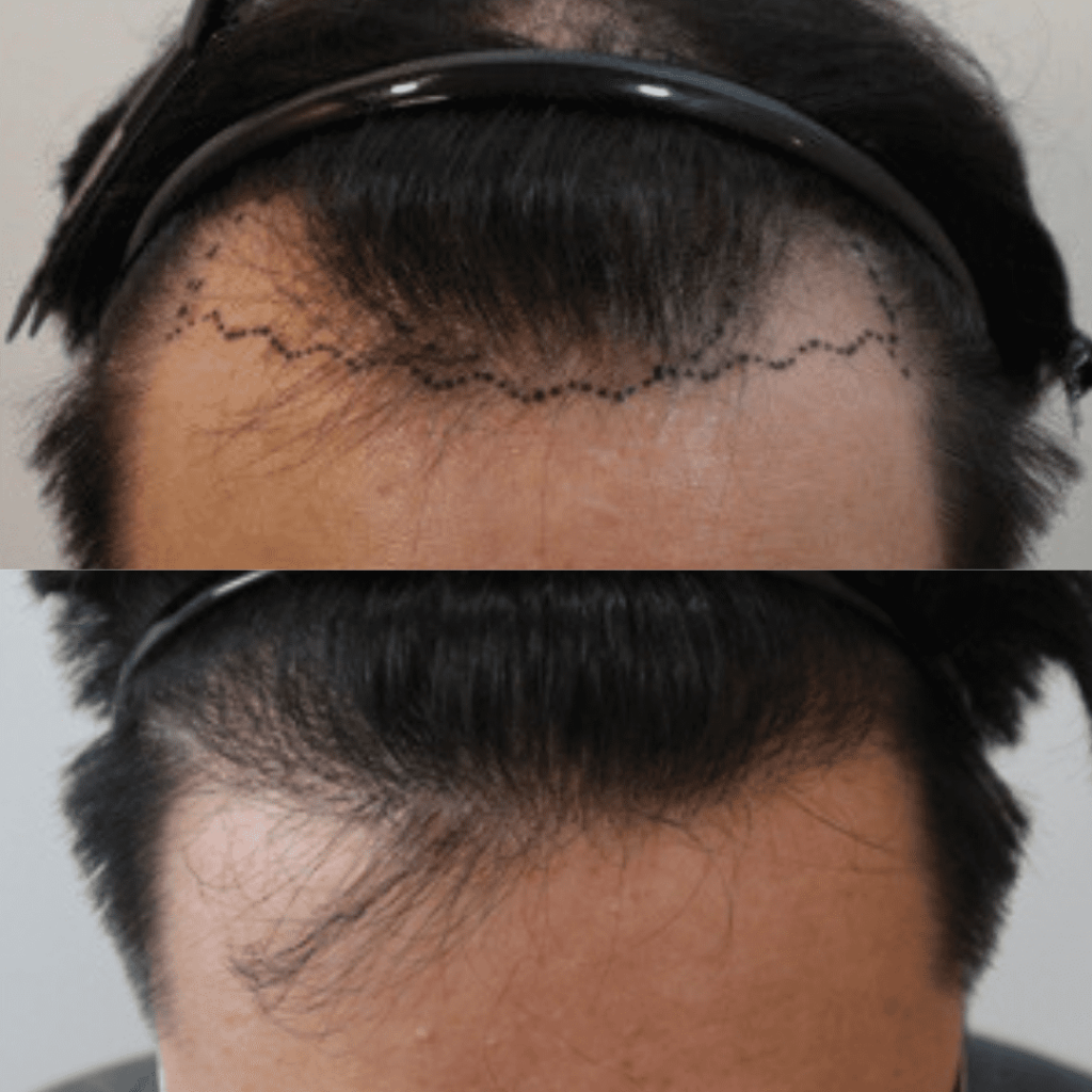 Achieving Natural-Looking Results with Hair Transplants in Korea