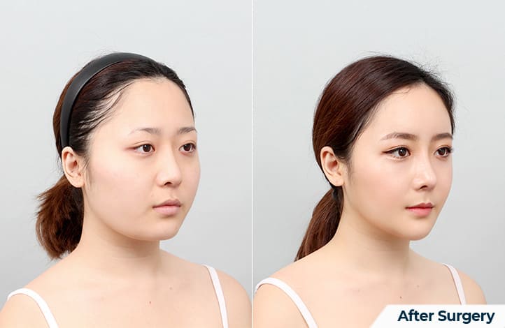 Achieving the Perfect V-shaped Facial Contour in Korea