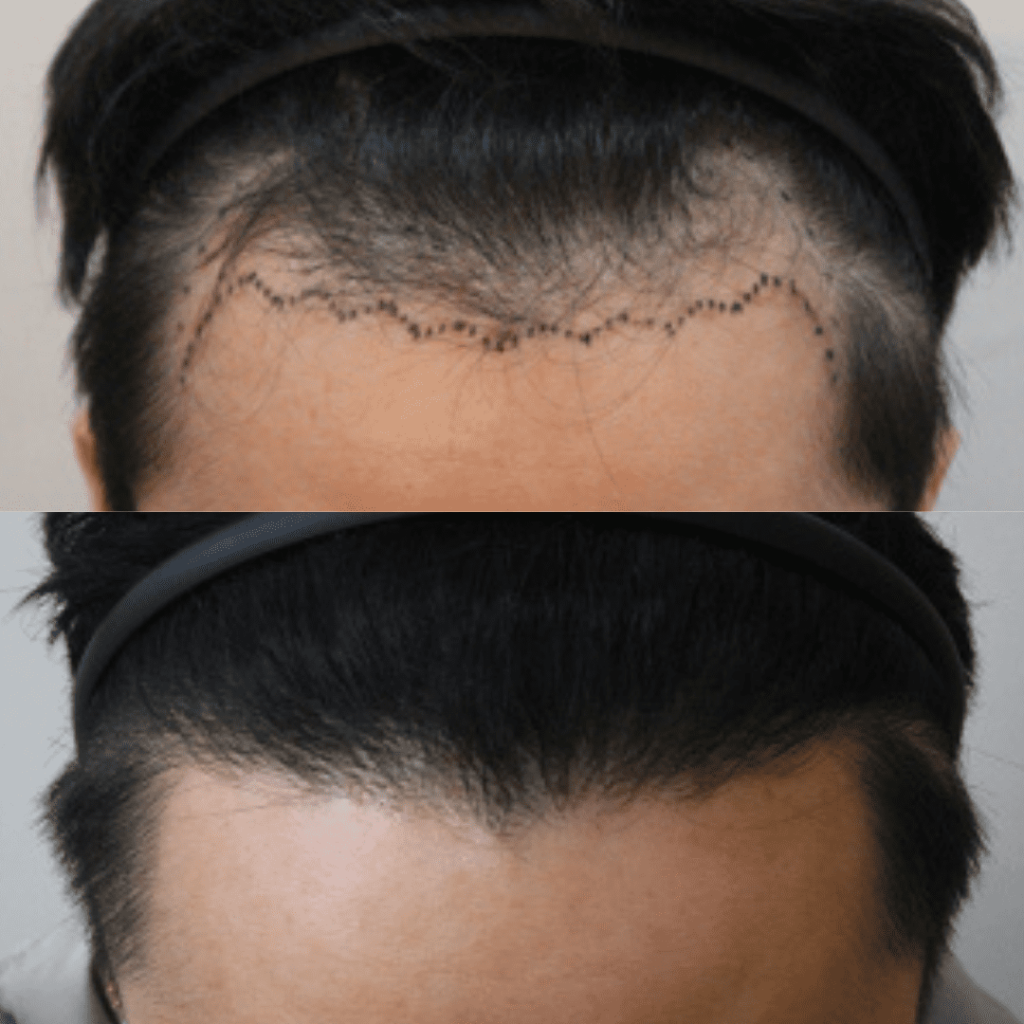 Addressing Baldness with Hair Transplant Solutions in Korea