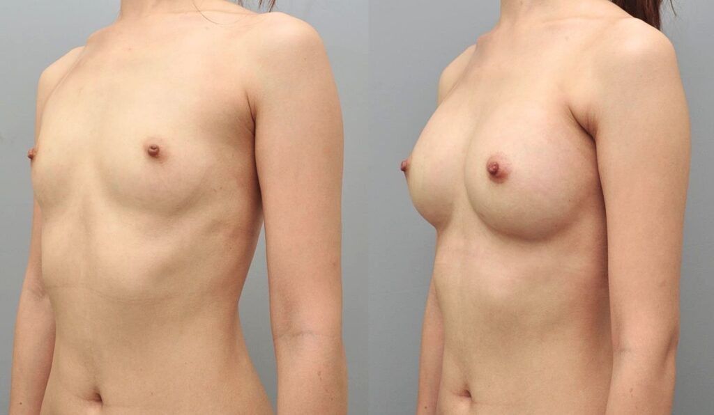 Advanced Techniques in Breast Augmentation in Korea