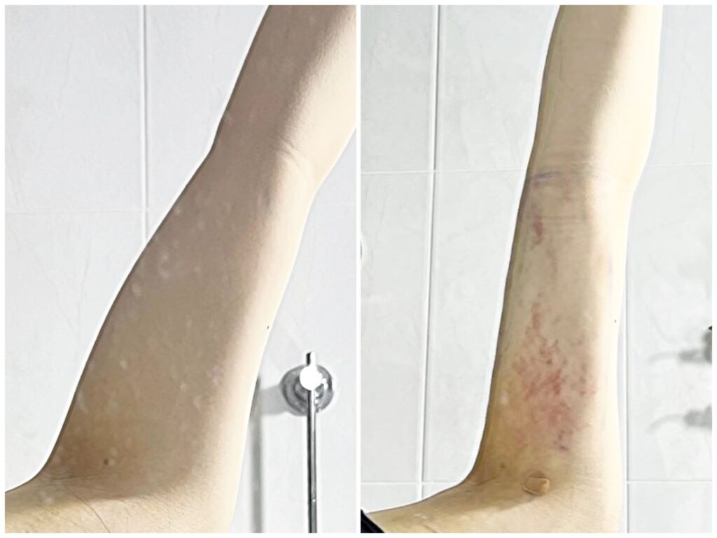 Advanced Technologies in Arm Liposuction in Korea