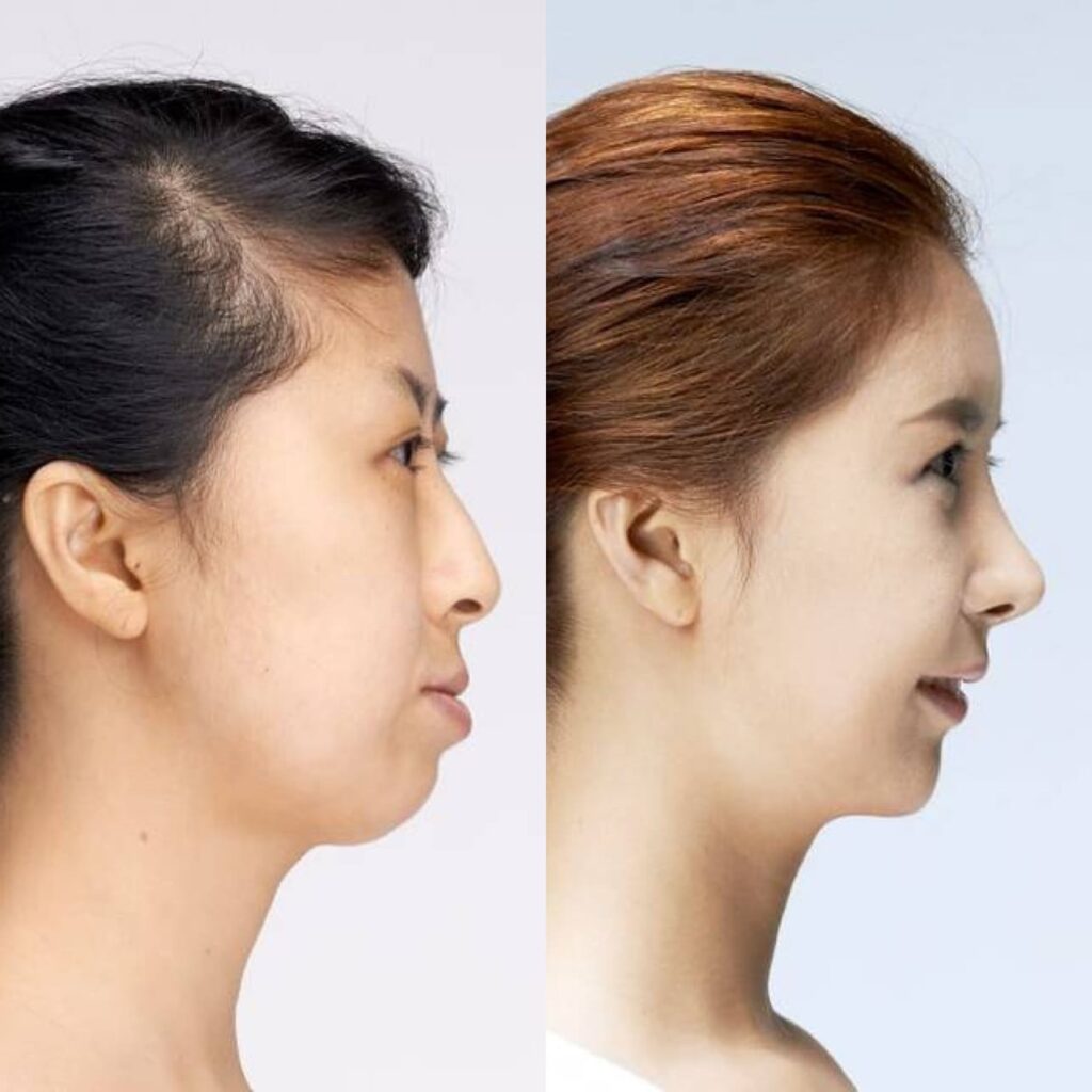 Advancements in Asian Nose Surgery in Korea