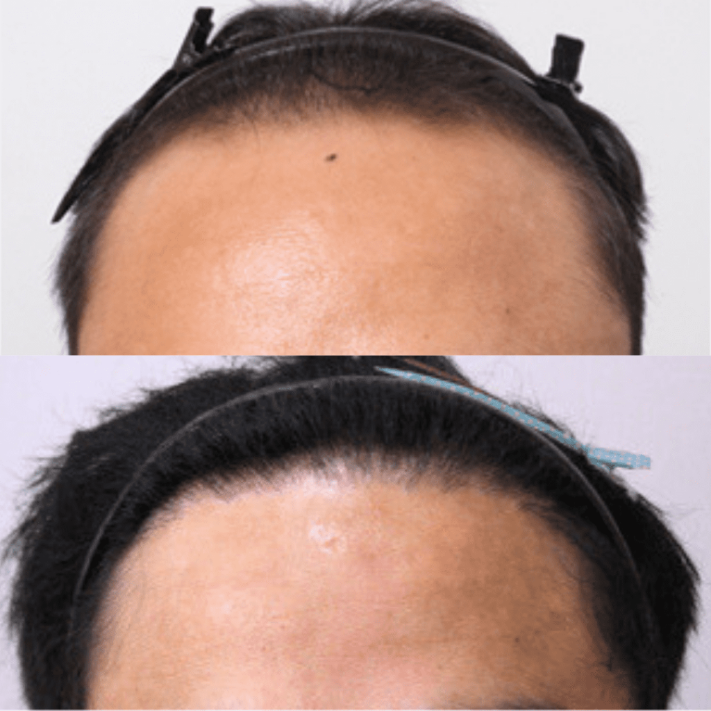 Advancements in Follicular Unit Transplantation in Korea