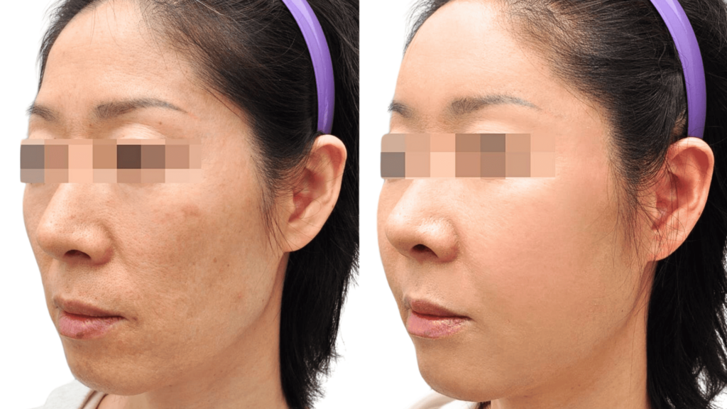 Advantages of thread lifting over plastic surgery in Korea