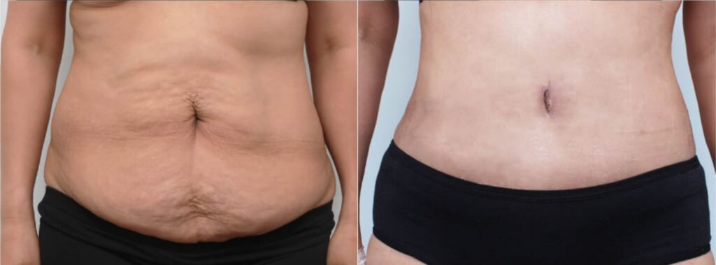 Aesthetic Aspects of Abdominoplasty in Korea