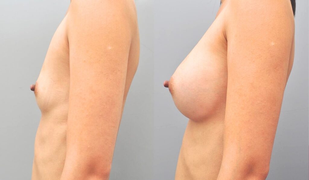 Aesthetic and Functional Benefits of Breast Implants in Korea