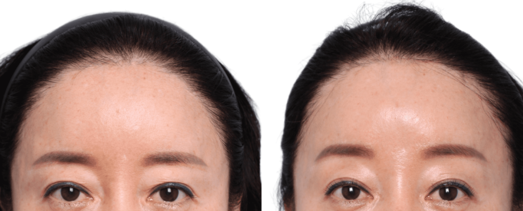 Aftercare Tips for Forehead Lift in Korea