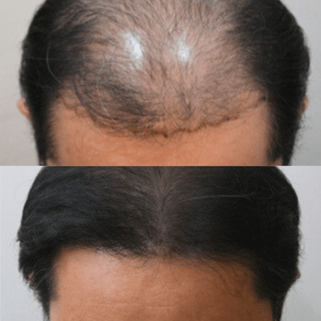 Aftercare Tips for Hair Transplant Patients in Korea