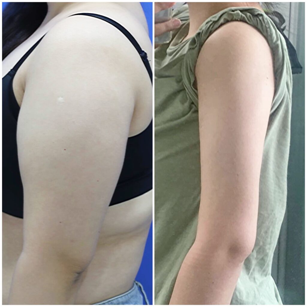 Age Restrictions for Arm Liposuction in Korea