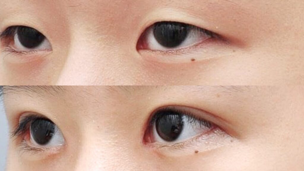 All You Need to Know About Blepharoplasty for Asian Eyes in Korea