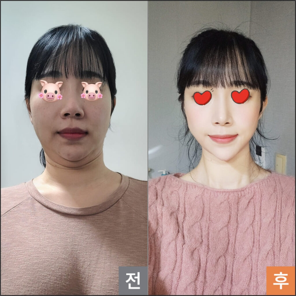 Altering Face Contours with Liposuction in Korea