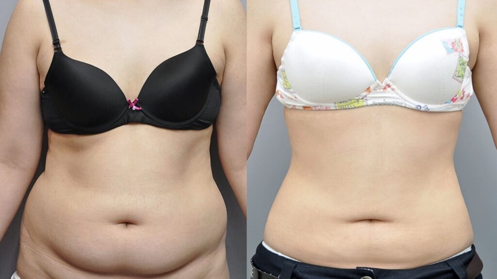 Alternatives to Abdominal Liposuction in Korea