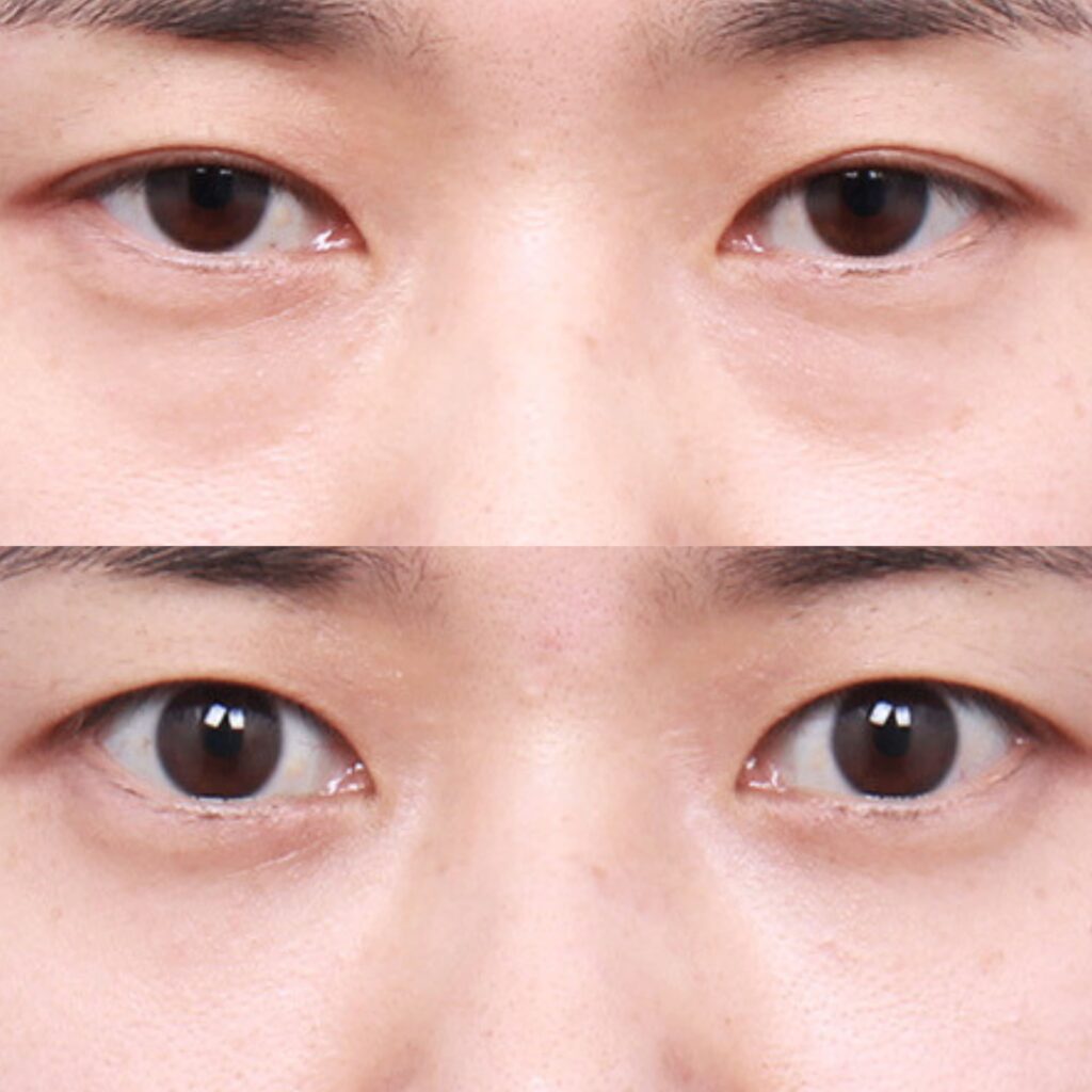 Anesthesia Methods for Inner Eyelid Surgery in Korea