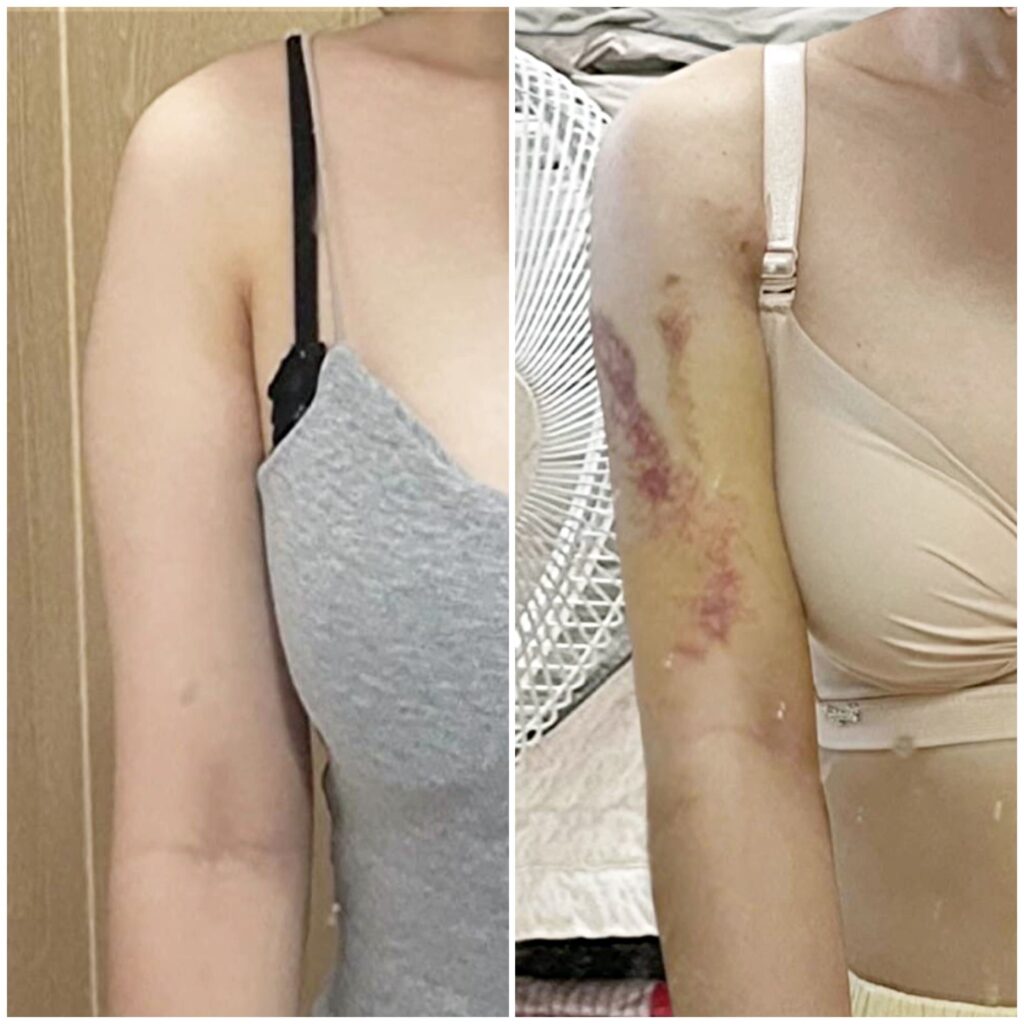 Anesthesia in Arm Liposuction in Korea