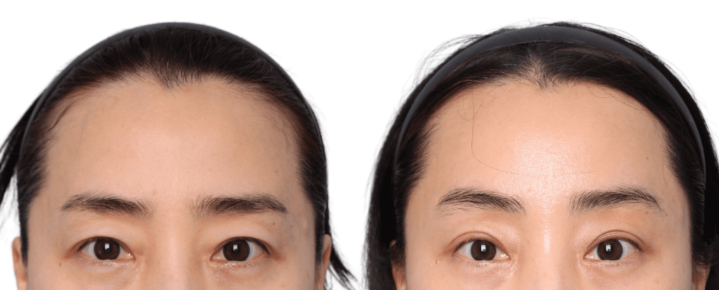 Anesthesia in Forehead Lift in Korea