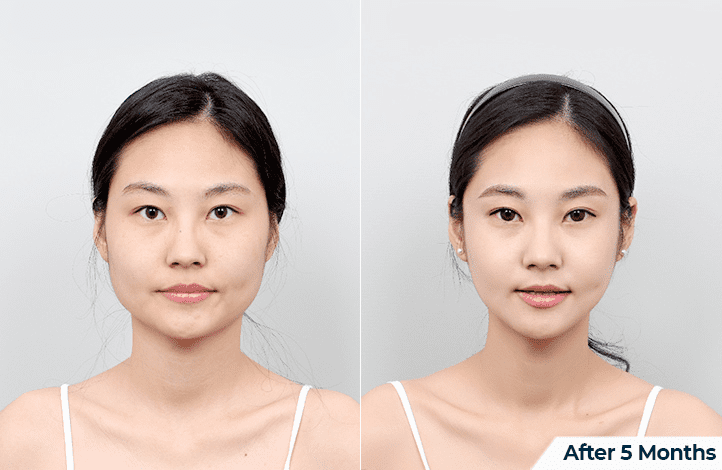 Approaches to Cheek Correction in Plastic Surgery in Korea