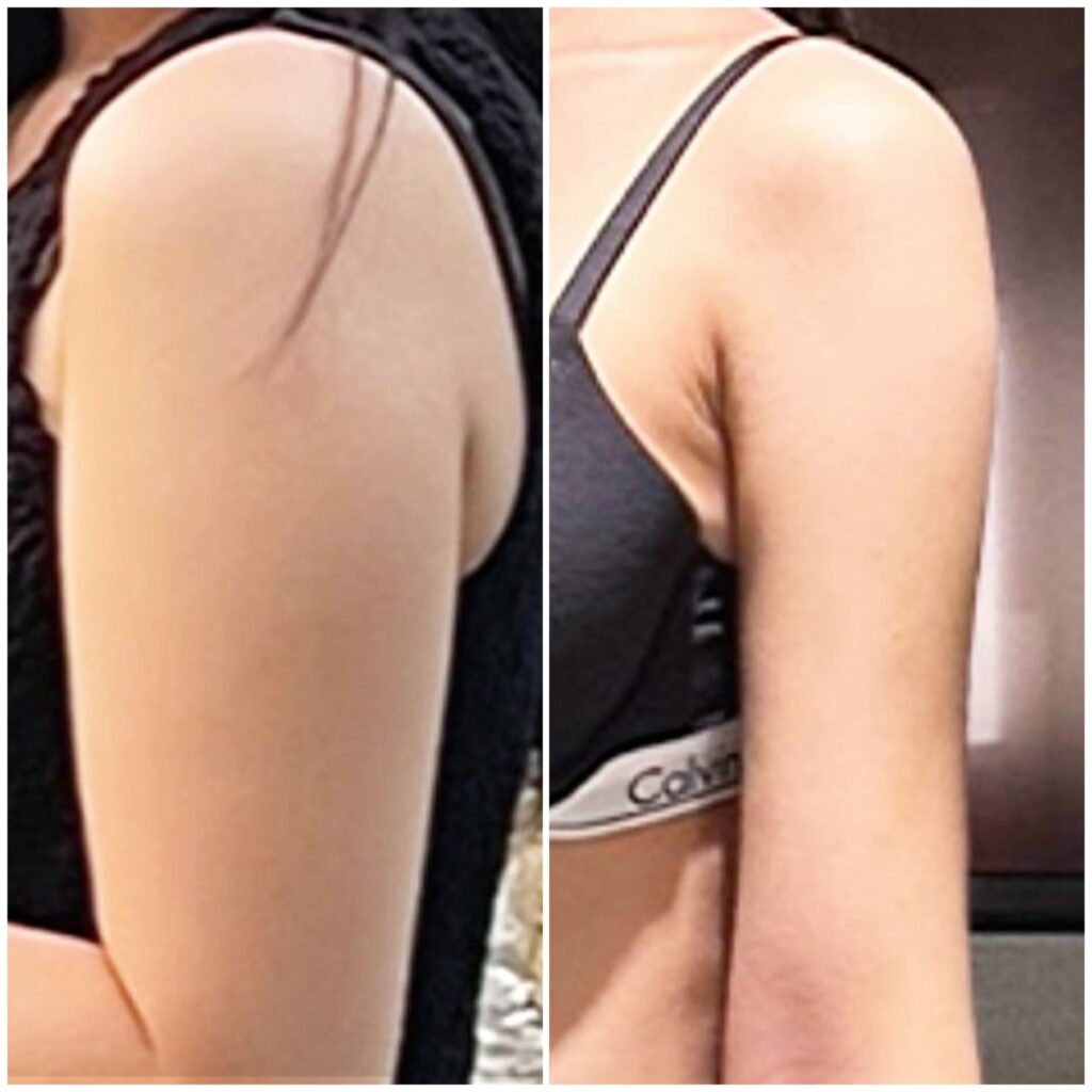 Arm Contouring After Liposuction in Korea