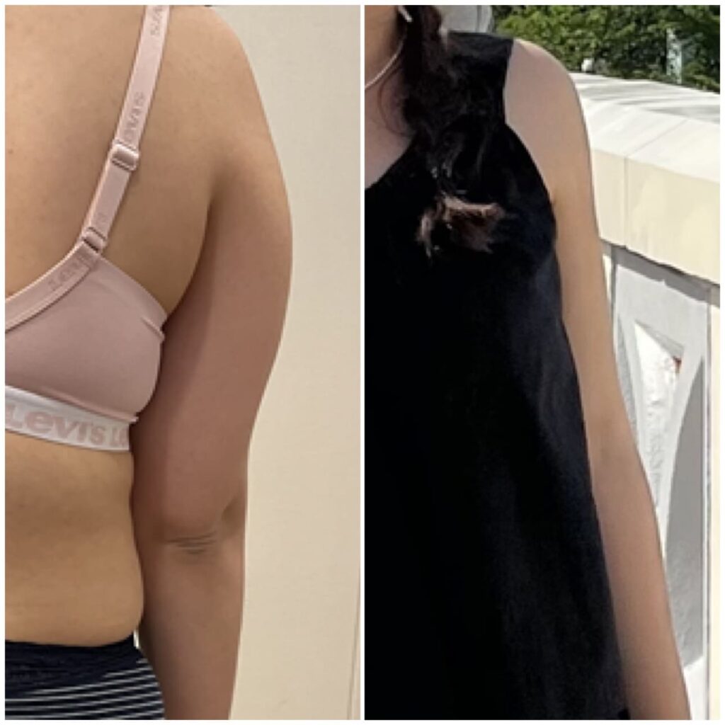 Arm Liposuction Results in Korea