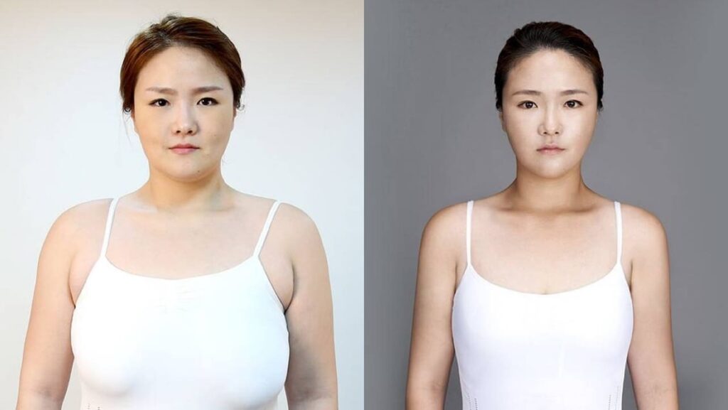 Arm Liposuction and Cellulite in Korea