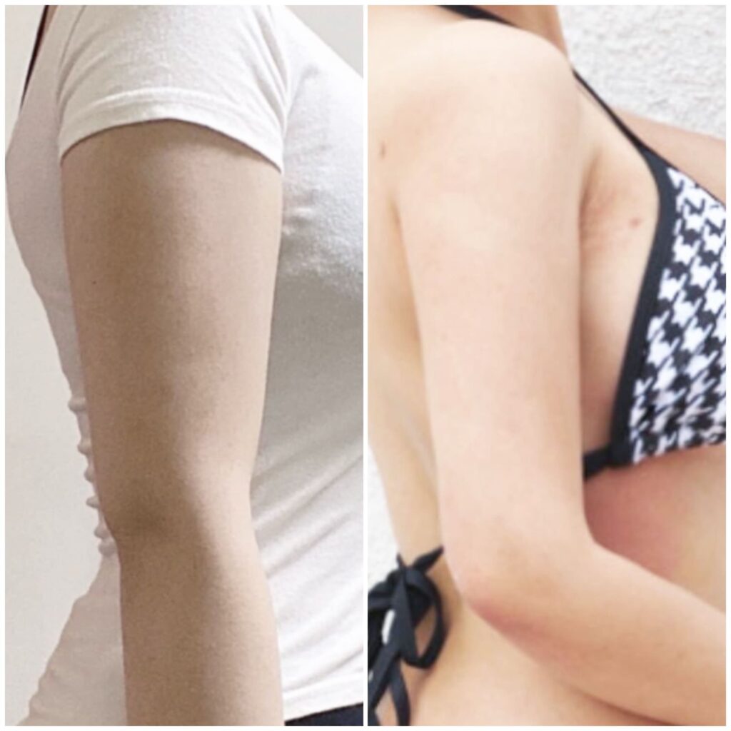 Arm Liposuction and Fitness in Korea