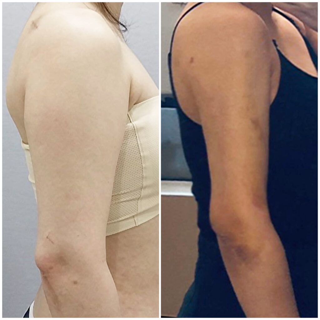 Arm Liposuction and Laser Correction in Korea