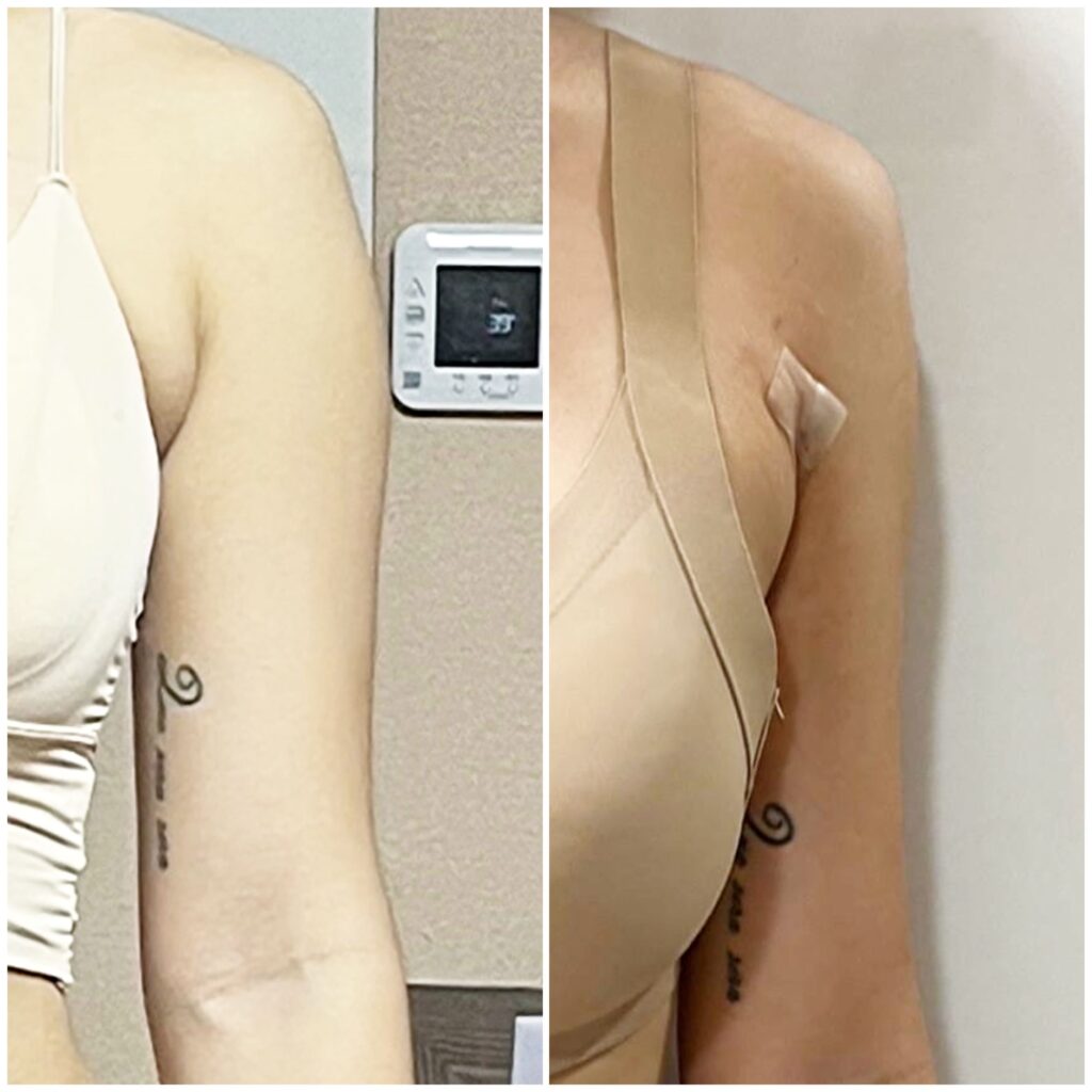 Arm Liposuction for Men in Korea