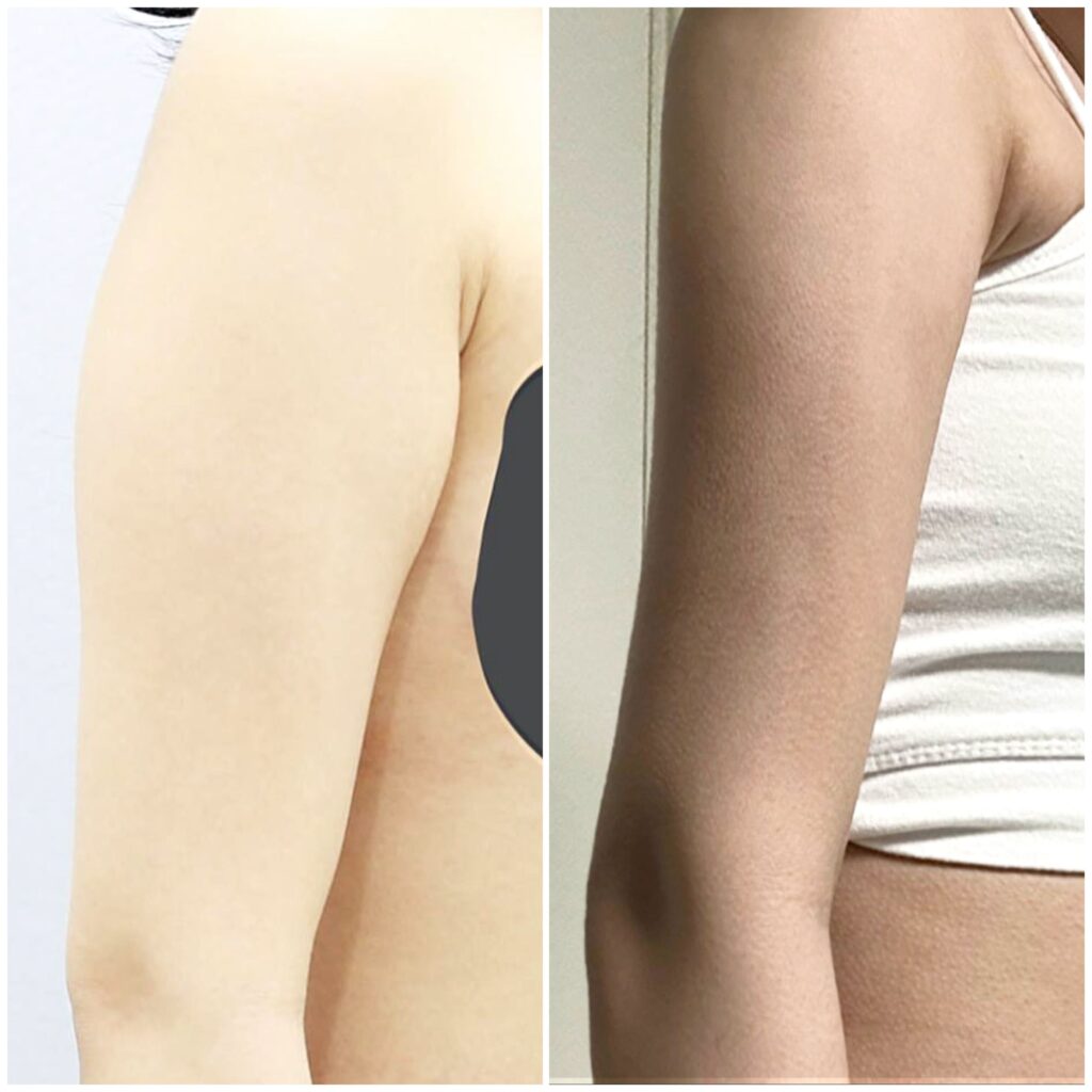 Arm Liposuction for Women in Korea