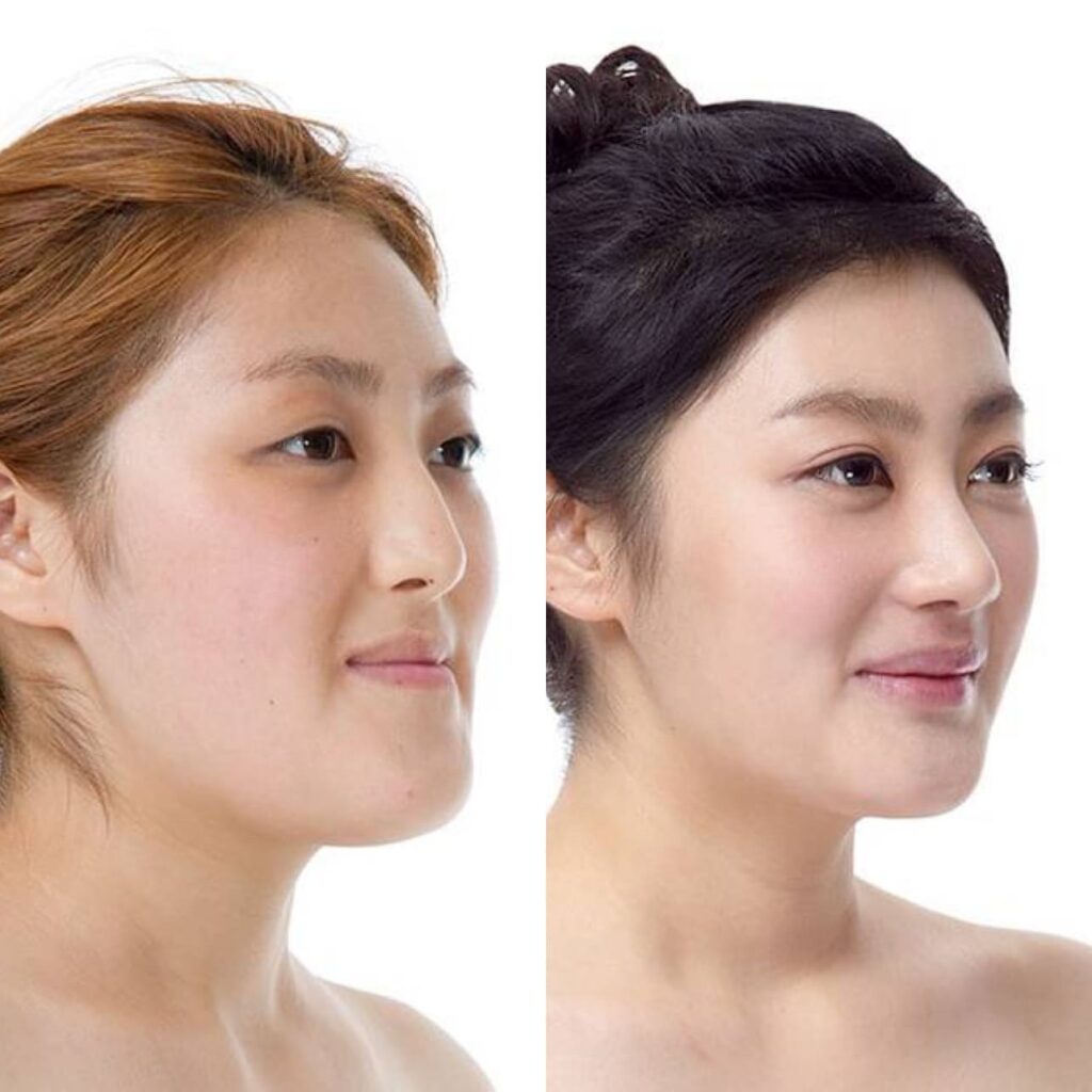 Asian Beauty_ Rhinoplasty in Korea