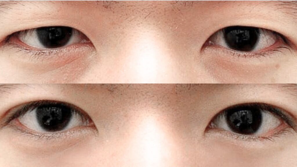 Asian Blepharoplasty Procedure_ A Comprehensive Guide in Korea