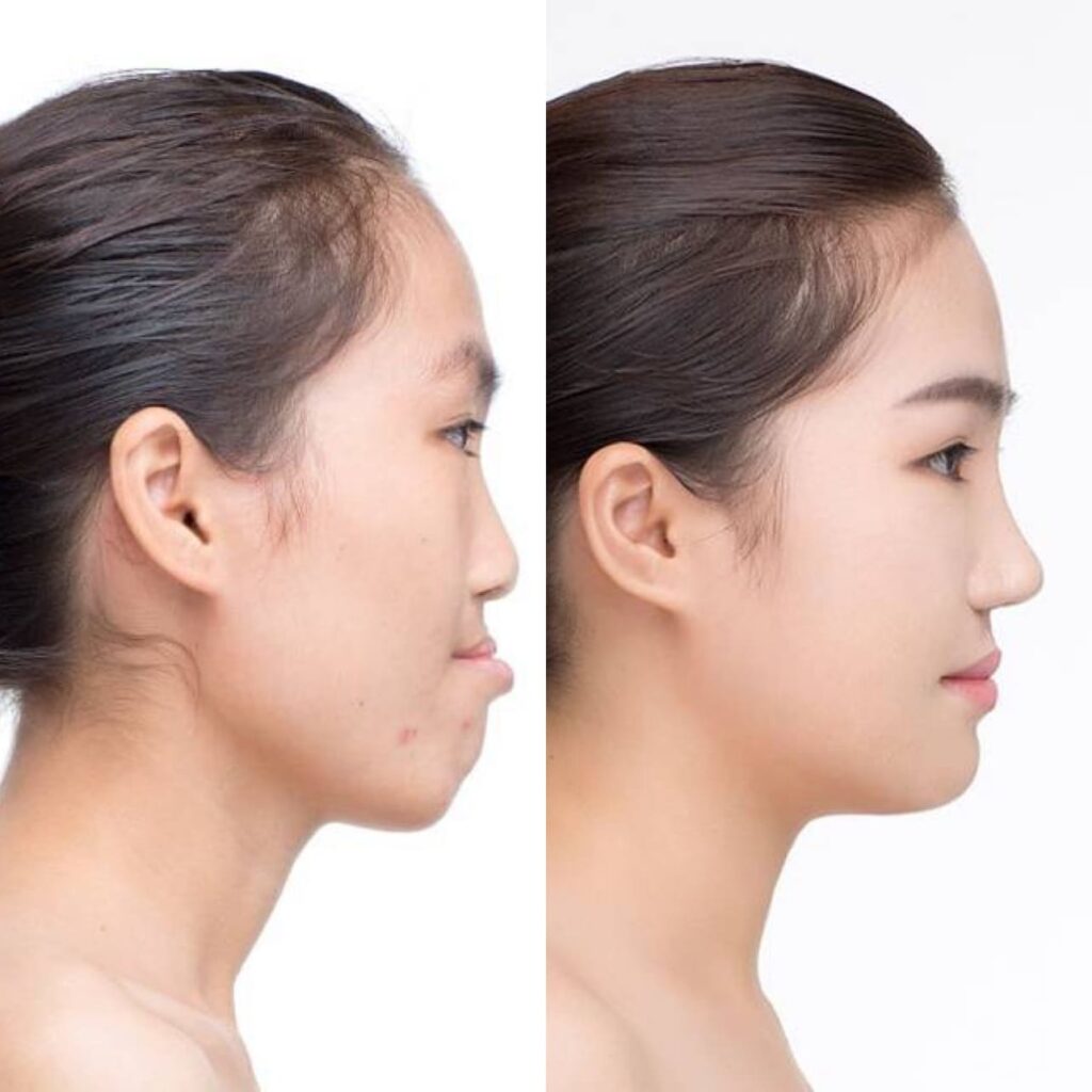 Asian Nose Enhancement Techniques in Korea