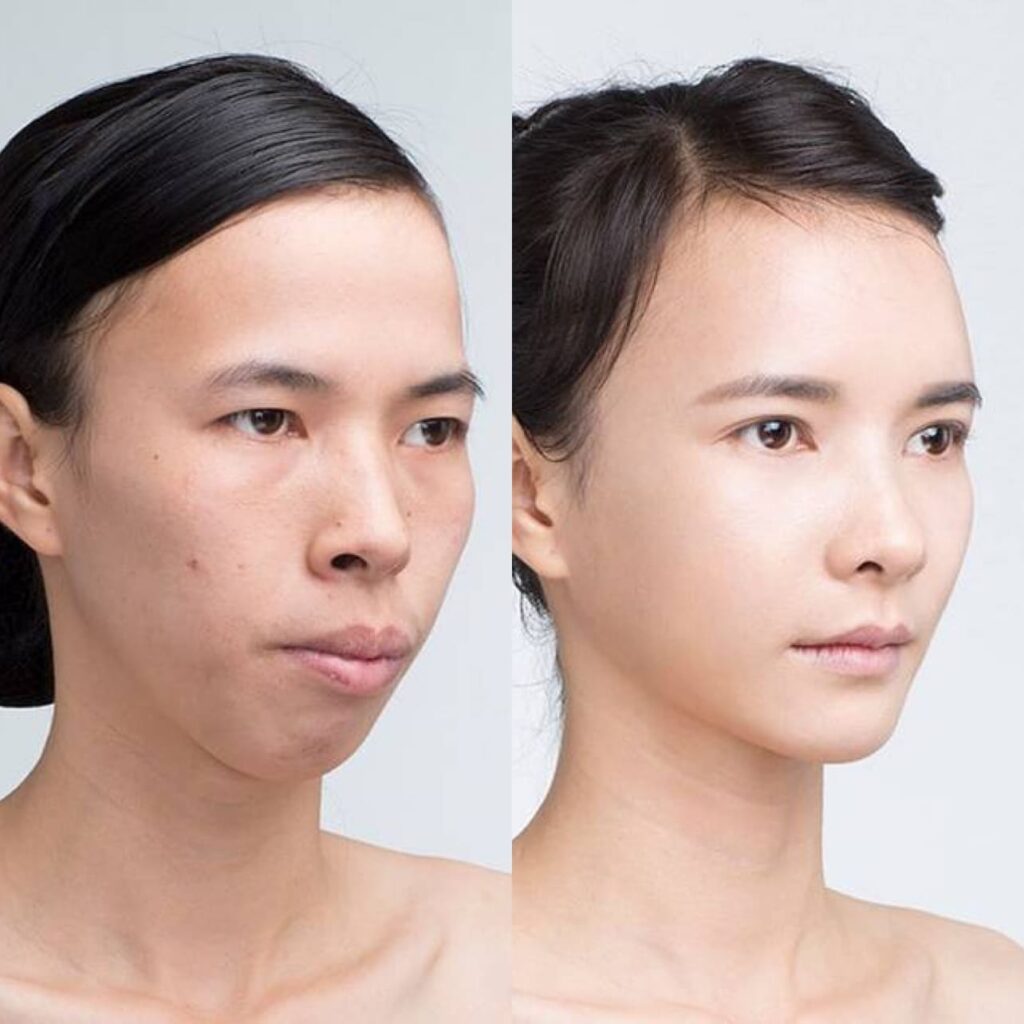 Asian Nose Reconstruction in Korea